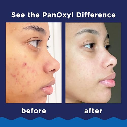 PanOxyl 10% Benzoyl Peroxide Acne Foaming Wash – Maximum Strength Face & Body Cleanser 5.5 oz – view 4